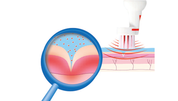 Ultraschallbehandlung für das Gesicht: Die Wirkung von emmi®-skin