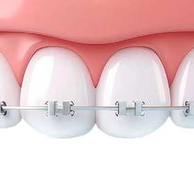 appareils orthodontiques et supports